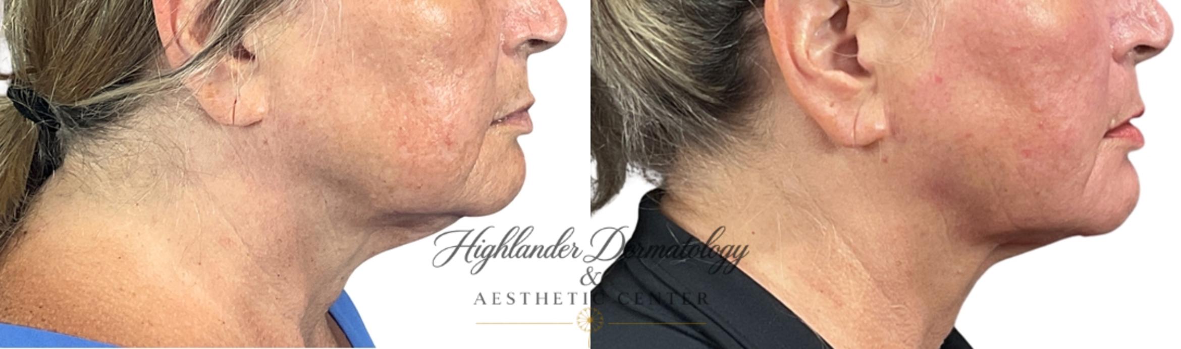 Before & After RFAL Face Case 17 Right Side View in Brookfield, Franklin, Wisonsin