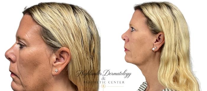 Before & After RFAL Face Case 3 Left Oblique View in Brookfield, Franklin, Wisonsin