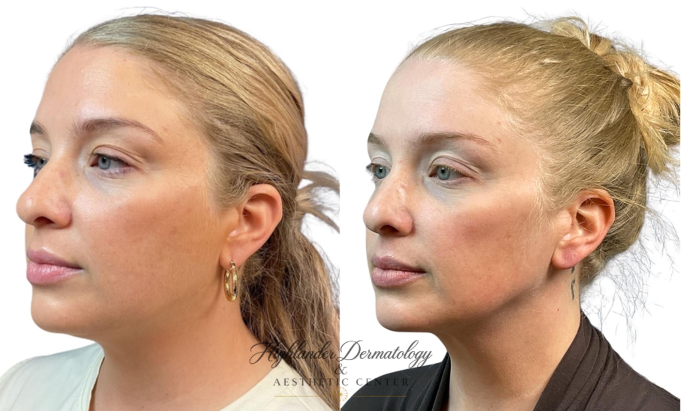 Before & After FaceTite Case 32 Left Oblique View in Brookfield, Franklin, Wisonsin