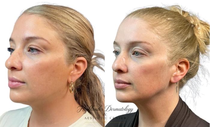 Before & After FaceTite Case 32 Left Oblique View in Brookfield, Franklin, Wisonsin