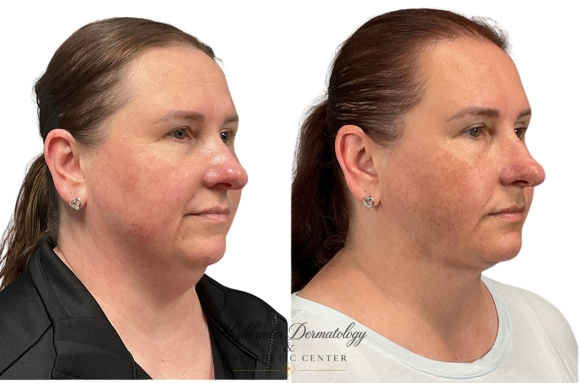 Before & After RFAL Face Case 4 Left Side View in Brookfield, Franklin, Wisonsin