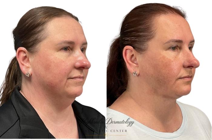 Before & After RFAL Face Case 4 Left Side View in Brookfield, Franklin, Wisonsin
