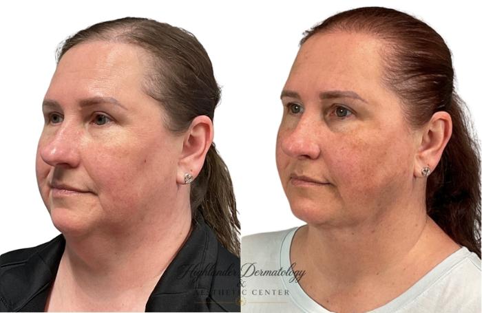 Before & After RFAL Face Case 4 Right Side View in Brookfield, Franklin, Wisonsin